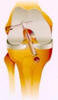 Riabilitazione del ginocchio dopo Ricostruzione del Legamento Crociato Anteriore